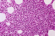 image001.jpg (353459 octets) : Case 1. BM lymphocytosis, reactive process.