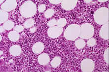 image003.jpg (324188 octets) : Case 3. Chronic Lymphocytic Leukaemia (CLL).