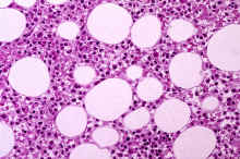 image004.jpg (340095 octets) : Case 4. Hairy Cell Disease.