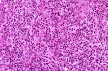 image005.jpg (372010 octets) : Case 5. Large Granular Lymphocyte Leukaemia.