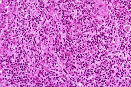 Case 5. Large Granular Lymphocyte Leukaemia.