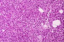 image006.jpg (366145 octets) : Case 6. Large Granular Lymphocyte Leukaemia.