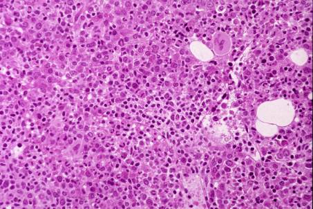 Case 6. Large Granular Lymphocyte Leukaemia.