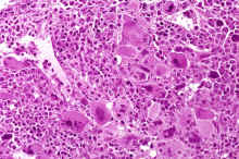image007.jpg (382429 octets) : Case 7. Postpolycythemia Myeloid Metaplasia.