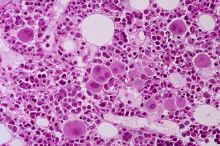 image009.jpg (365336 octets) : Case 9. Reactive BM in the context of an HIV infection.