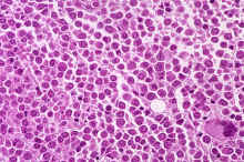 image010.jpg (340765 octets) : Case 10. Acute Myeloid Leukaemia M3 (FAB)