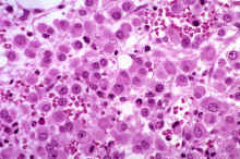 image012.jpg (283424 octets) : Case 12. Melanoma, metastatic.
